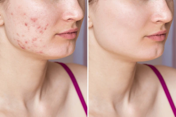 Top Tips to Cure Acne: Your Ultimate Guide to Clear, Healthy Skin